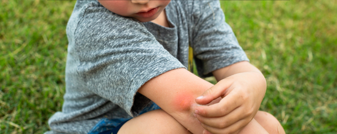 What is Overactive Histamine Response to Bug Bites